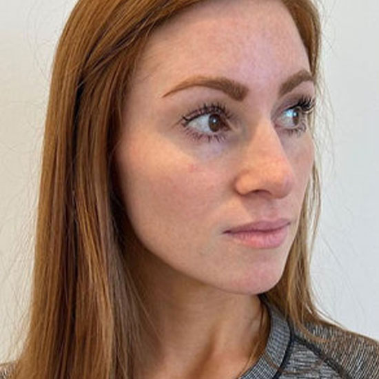 Fillers πριν και μετα