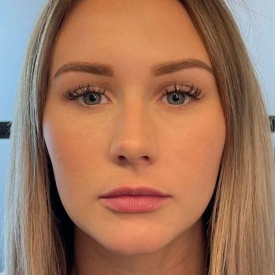 Fillers πριν και μετα