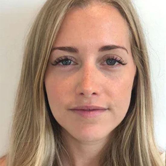 Fillers πριν και μετα