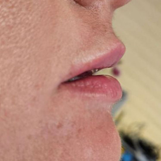 Fillers πριν και μετα