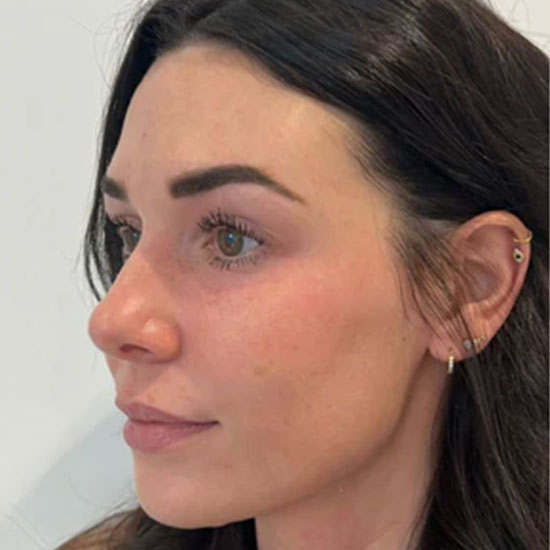 Fillers πριν και μετα