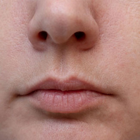 Fillers πριν και μετα